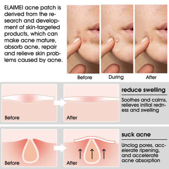 Elaimei Acne Pimple Patch Large Spot Remover Control Cover Long Size Hydrocolloid Strip for Breakouts Extra Coverage Stickers Facial Skin Care (20 patches)